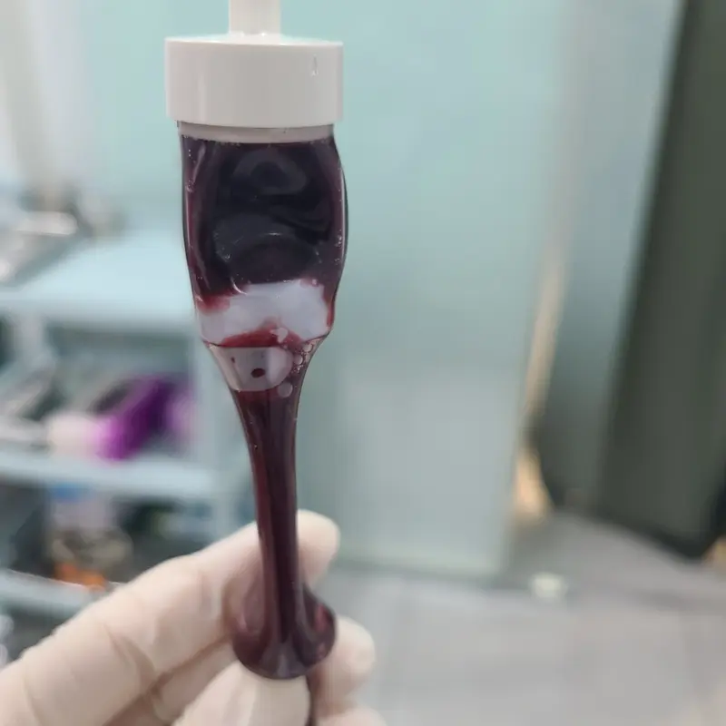 채혈 후 — 탁한 흑자색 혈액