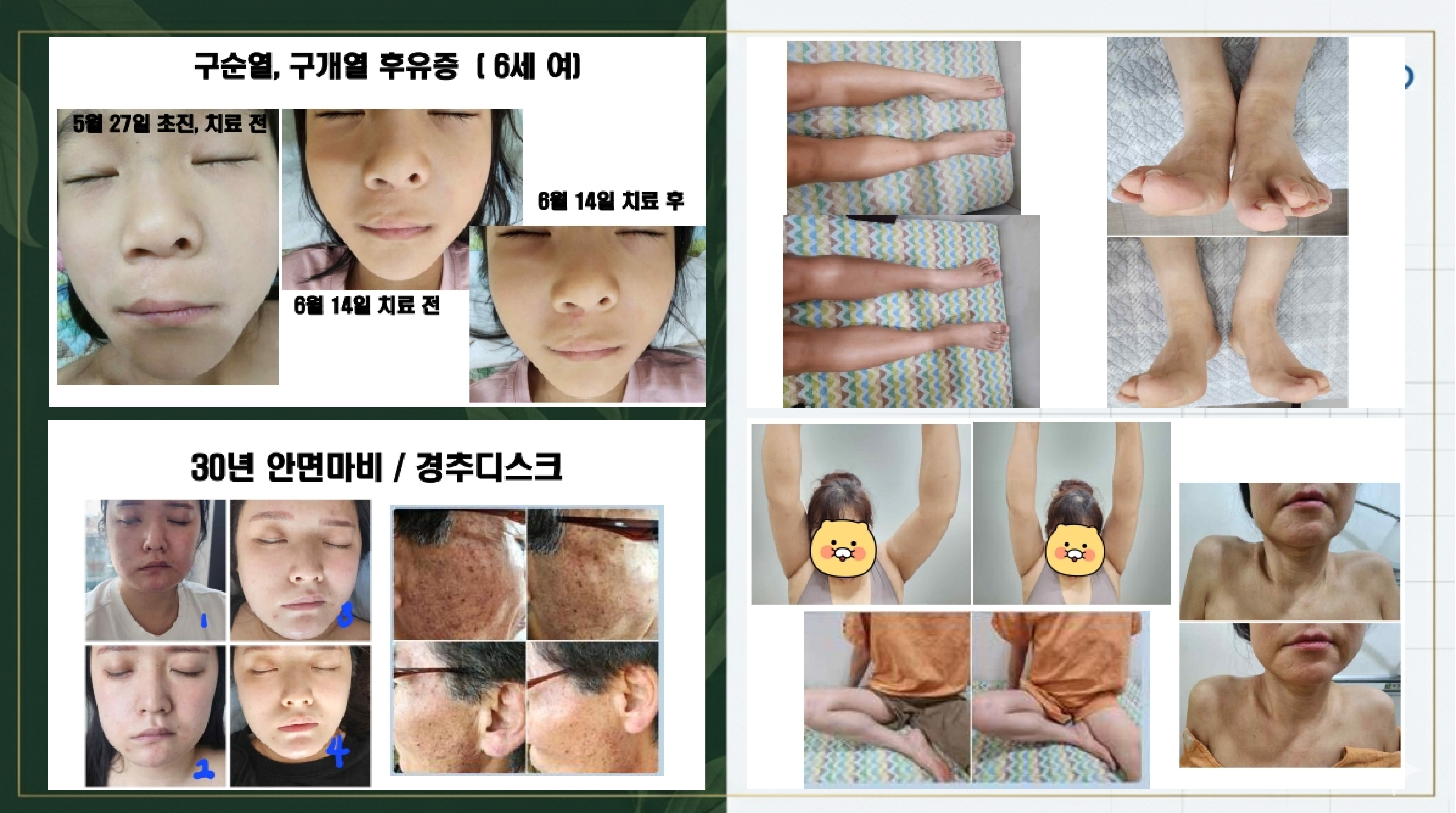 시술 사례 - 구순열/구개열 후유증, 30년 안면마비, 발 변형, 어깨