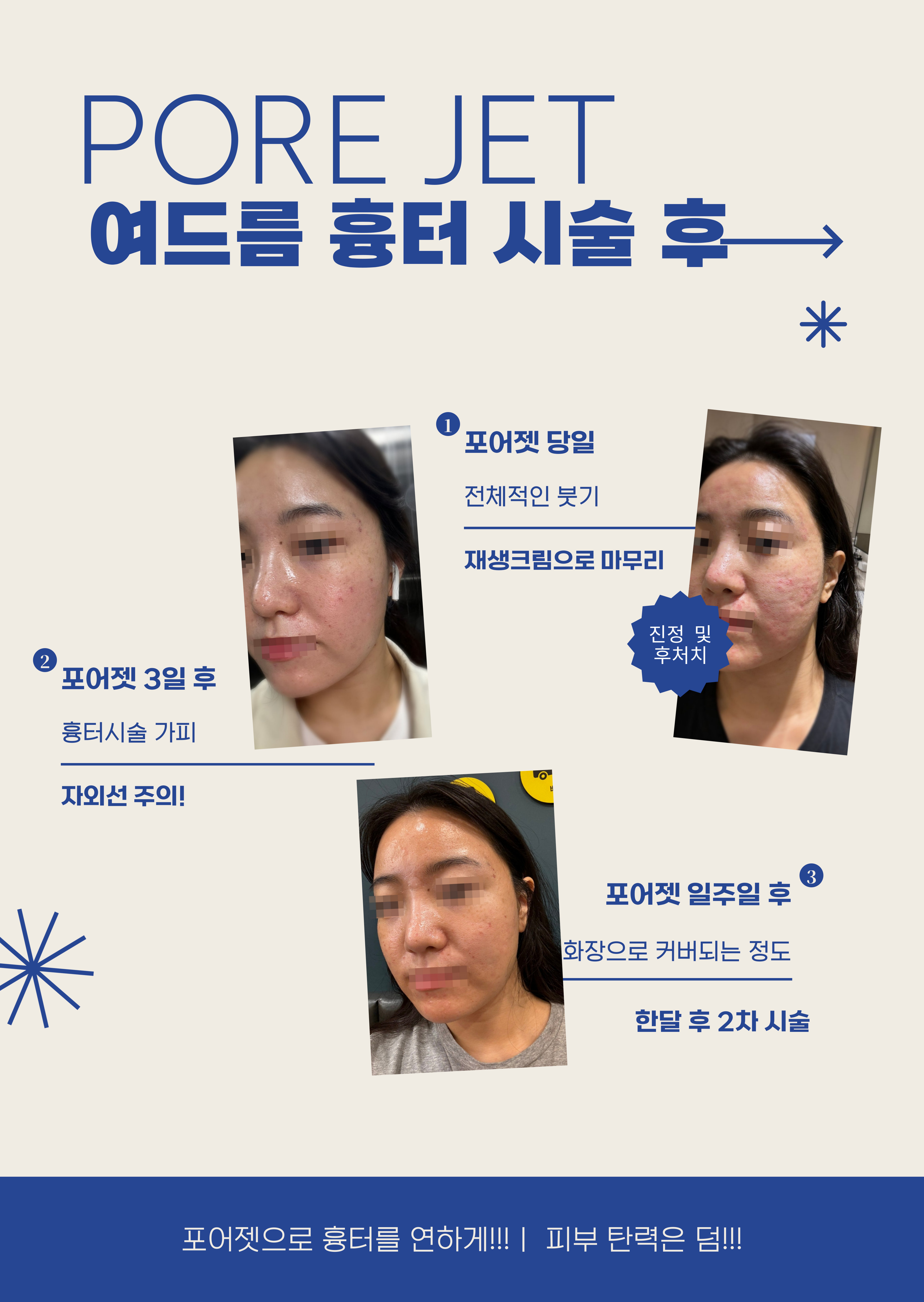 PORE JET acne scar treatment stages