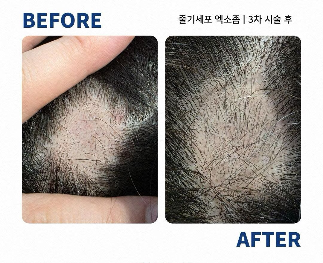 Scalp stem cell exosome 3rd session before after