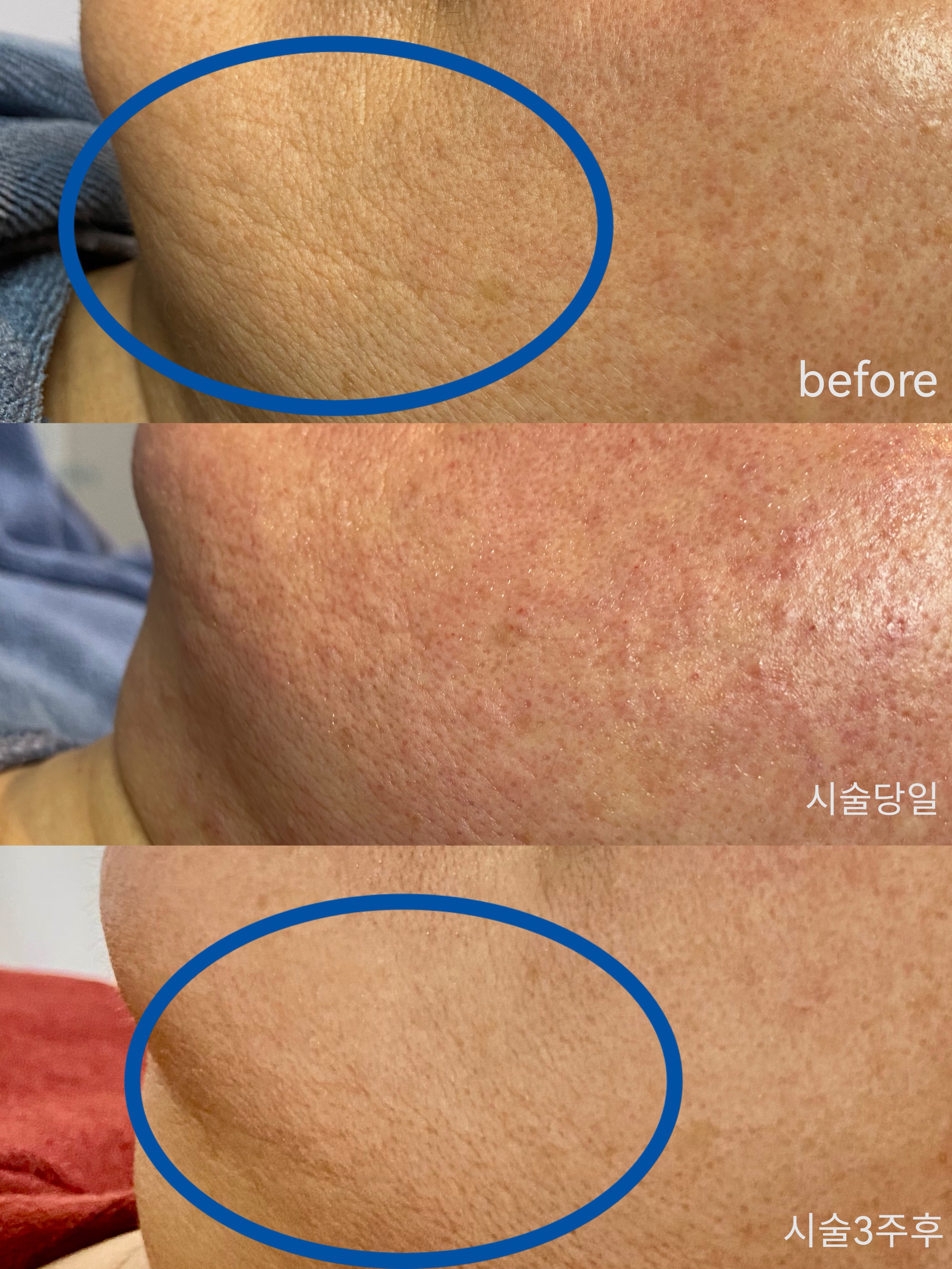 Skin: day of treatment vs 3 weeks after
